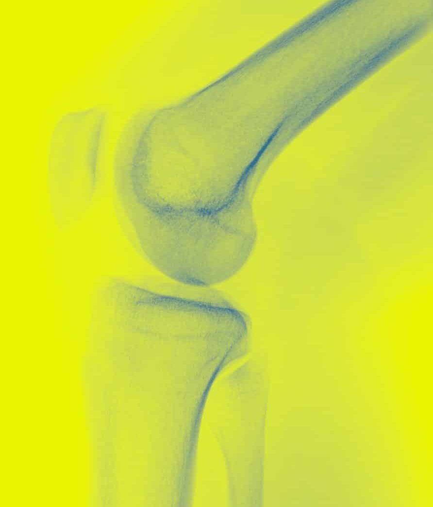 Knie Röntgen rechte Seite