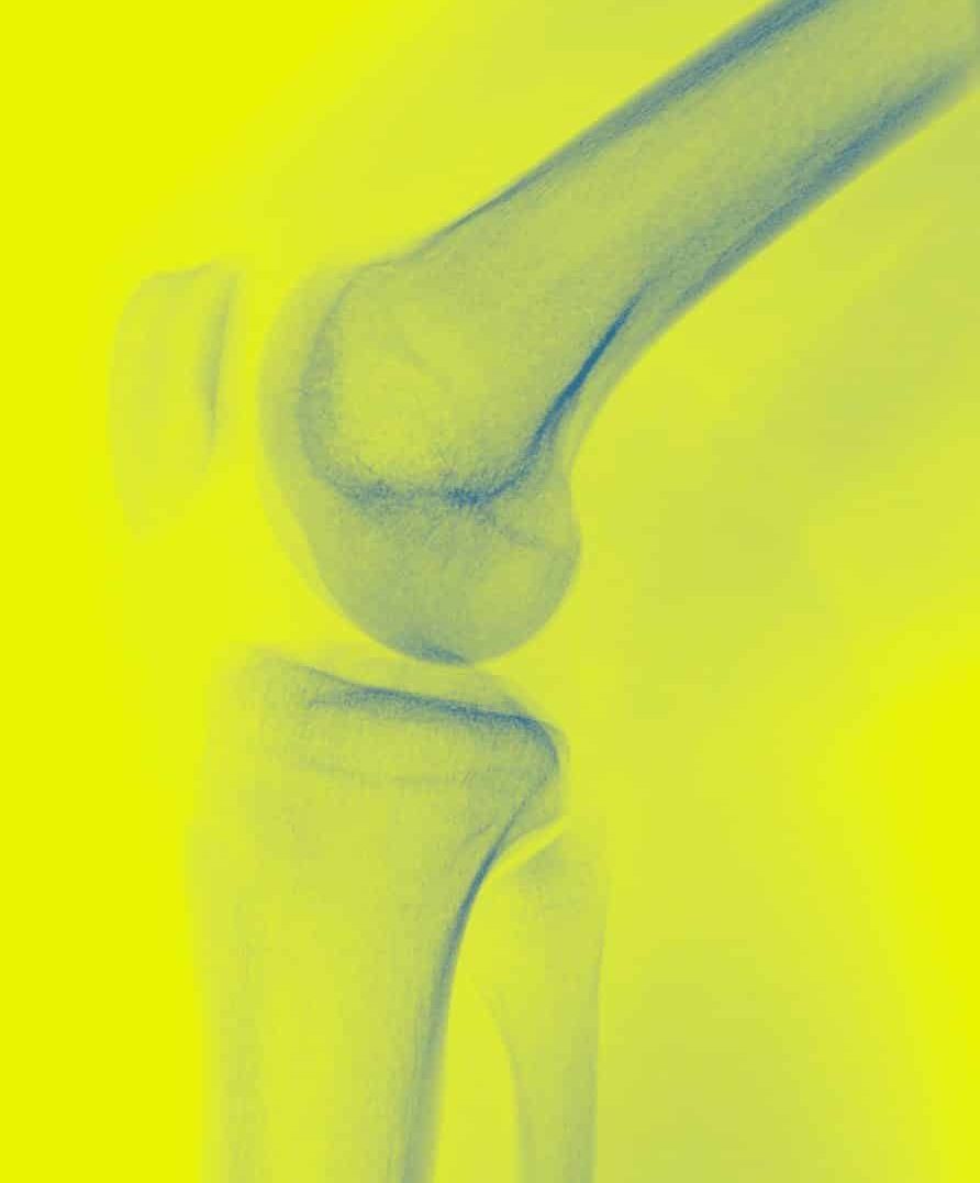 Knie Röntgen rechte Seite